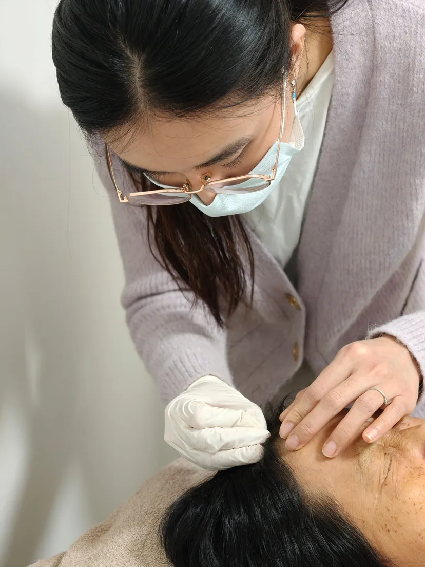 Acpuncture needle scalp