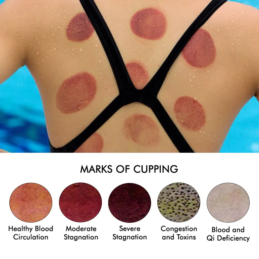Cupping marks chart