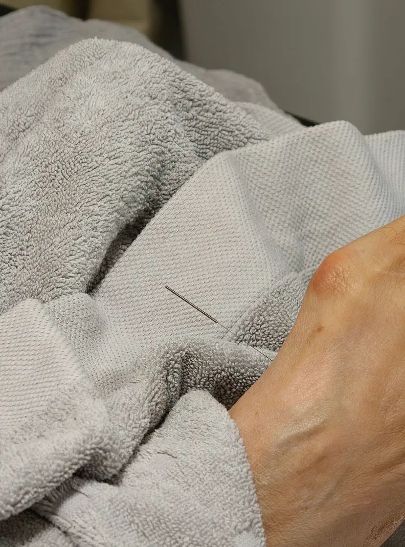 Distal acupuncture needle in hand